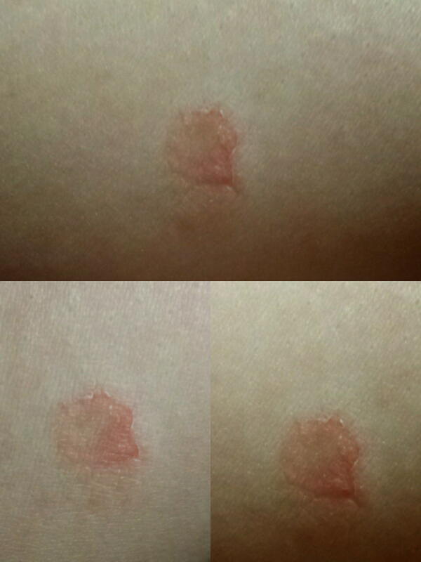 Scariest Rash Weird rash – Hejbea