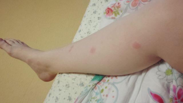 Oh no mosquito bites&nbsp;🦟🦟🦟